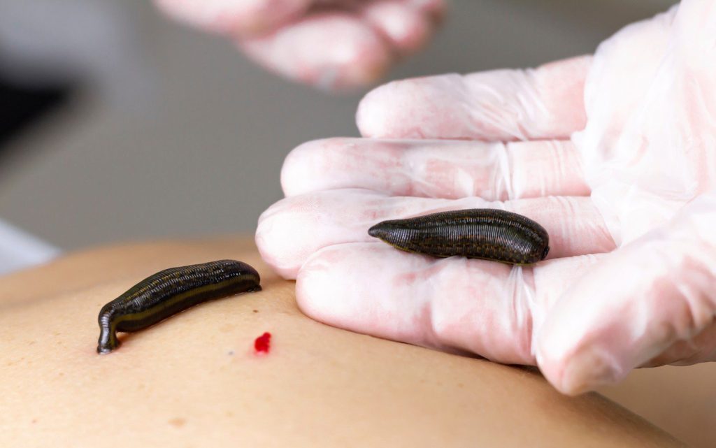Doctor putting leech on human patient
