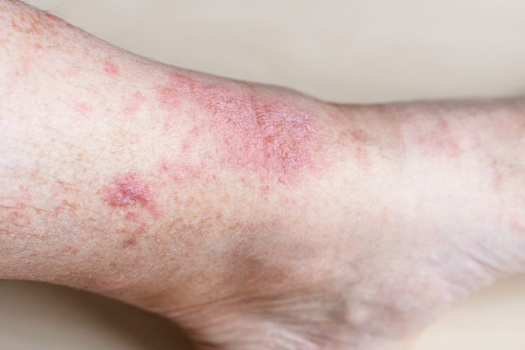 Close up of bed bug bites and rash on ankle