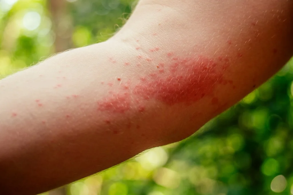 Rash on arm from chigger bites
